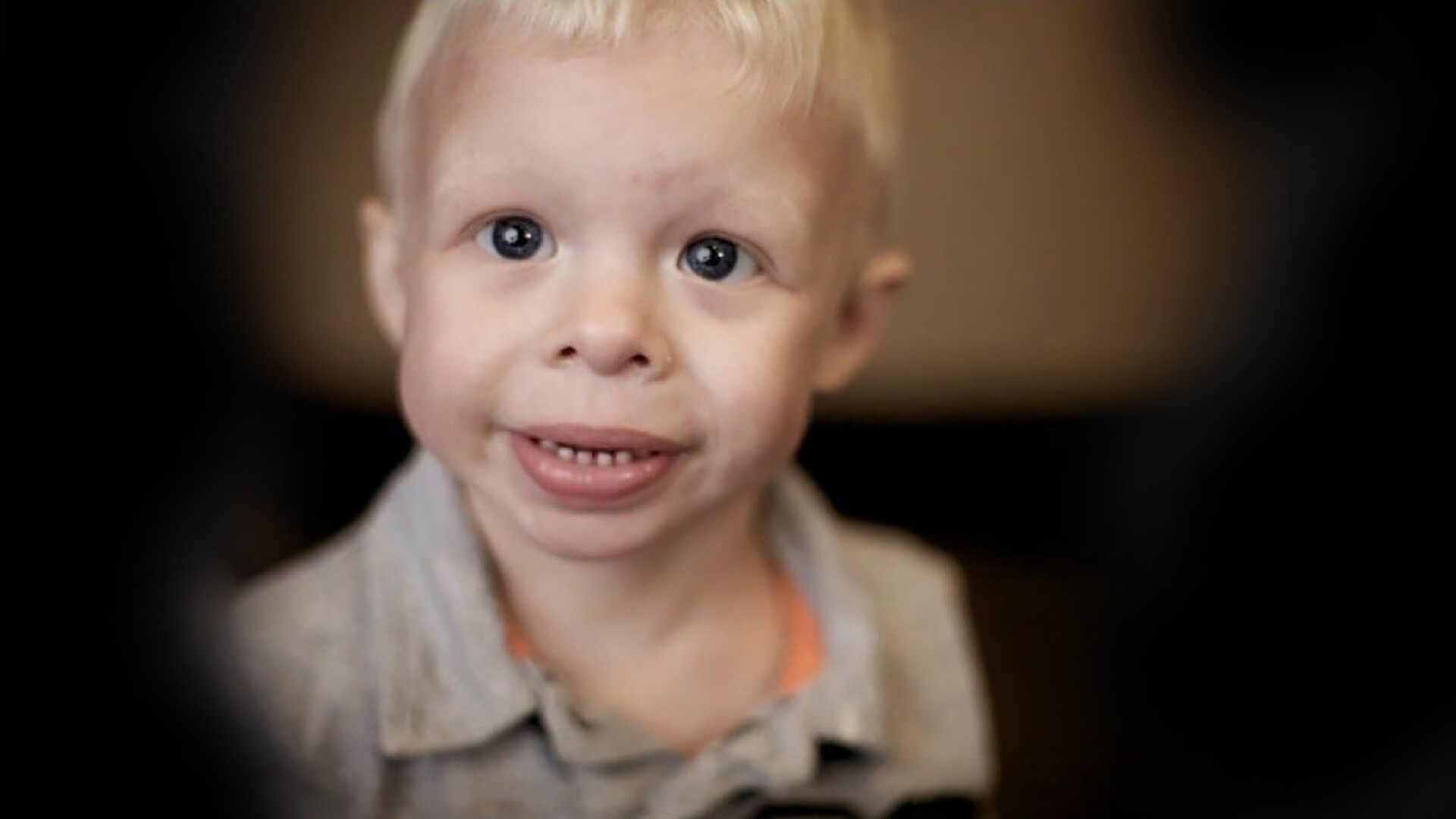 Síndrome de William